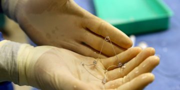 CORolla, implante israelí para tratar la insuficiencia cardíaca probado por primera vez