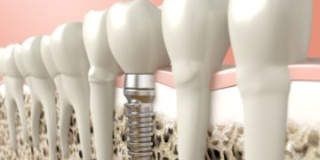 nuevo implante dental de alta tecnología israelí mejora el crecimiento de los huesos
