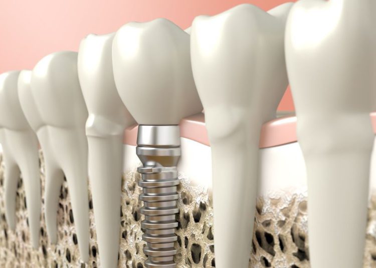 nuevo implante dental de alta tecnología israelí mejora el crecimiento de los huesos