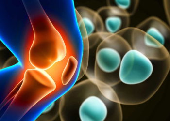 Empresa israelí revoluciona la regeneración del cartílago en la rodilla