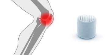 Innovador implante de rodilla inventado en Israel utilizado por primera vez - Agili-C