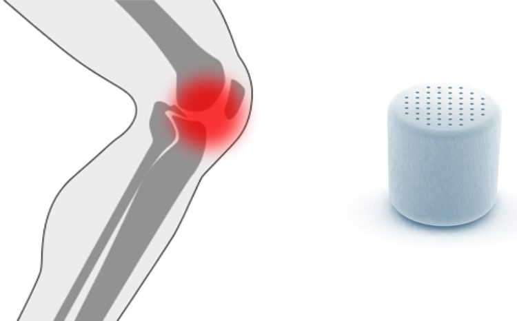 Innovador implante de rodilla inventado en Israel utilizado por primera vez - Agili-C