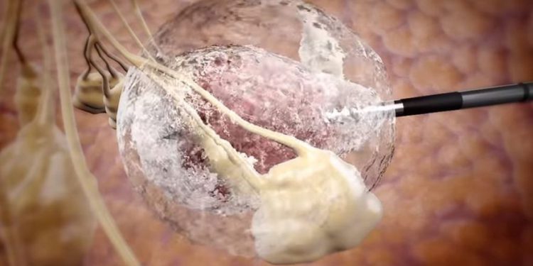 Compañía biomédica israelí IceCure informa éxito al destruir tumores con hielo en prueba de cáncer de mama