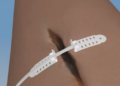 Dispositivo israelí para cerrar heridas tiene como objetivo reemplazar la sutura quirúrgica en todo el mundo