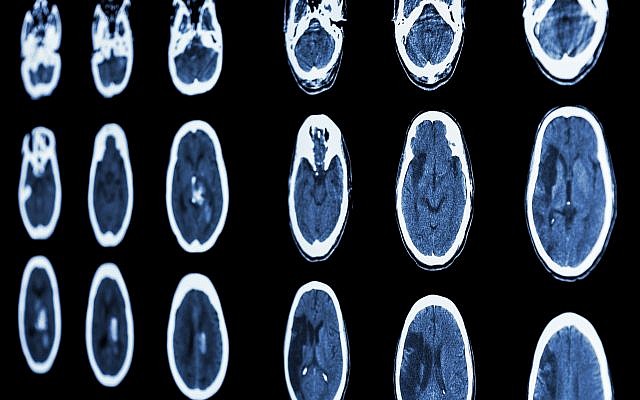 Una tomografía computarizada ilustrativa de un cerebro muestra un ictus isquémico y un ictus hemorrágico (stockdevil; iStock by Getty Images)