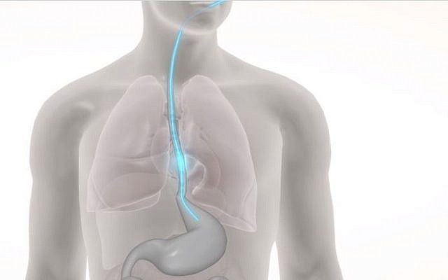El dispositivo desarrollado por E-Motion Medical es un tubo que se puede insertar en pacientes como un tubo de alimentación, que ayuda a los pacientes con dismotilidad gastrointestinal aguda (GID) a tragar nuevamente (captura de pantalla de Vimeo)
