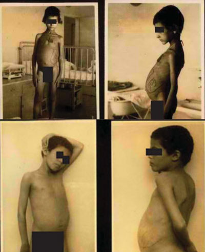 Fotografías tomadas entre 1948-1955 de niños yemeníes hospitalizados en el Hospital Rambam, Haifa (Archivos del Estado de Israel)