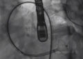 El profesor Victor Guetta, director de la Unidad de Cardiología Invasiva e Intervencionista del Centro Médico Sheba, tapó un orificio de sangrado en la arteria de un paciente de 29 años que usa un dispositivo que generalmente se usa para desbloquear arterias (captura de pantalla de YouTube)