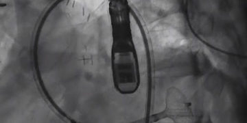 El profesor Victor Guetta, director de la Unidad de Cardiología Invasiva e Intervencionista del Centro Médico Sheba, tapó un orificio de sangrado en la arteria de un paciente de 29 años que usa un dispositivo que generalmente se usa para desbloquear arterias (captura de pantalla de YouTube)