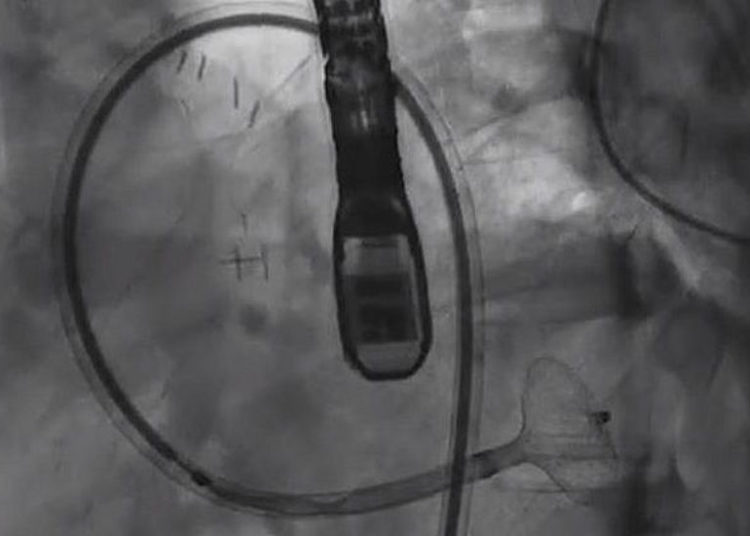 El profesor Victor Guetta, director de la Unidad de Cardiología Invasiva e Intervencionista del Centro Médico Sheba, tapó un orificio de sangrado en la arteria de un paciente de 29 años que usa un dispositivo que generalmente se usa para desbloquear arterias (captura de pantalla de YouTube)
