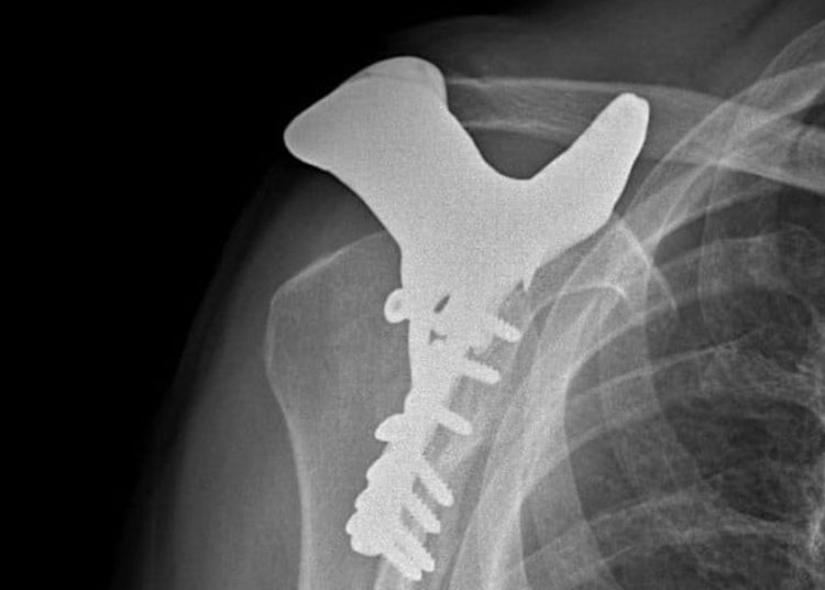 Por primera vez se realizó el implante de hueso impreso en 3D en Israel