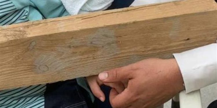 Niño israelí de 5 años hospitalizado con tabla de madera incrustada en la palma de sumano
