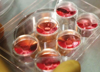 Médicos israelíes congelan óvulos de niña con síndrome de Turner