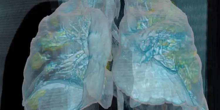 Video revela daño pulmonar en paciente de coronavirus: “Las personas deben tomar esto en serio”