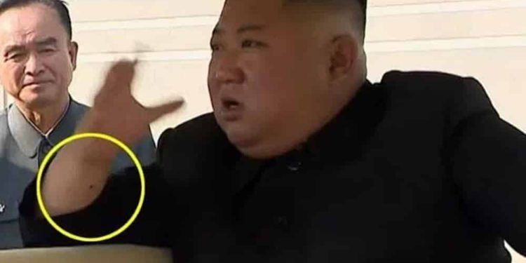 ¿Kim Jong Un tuvo una cirugía cardíaca? Las “marcas de aguja” en sus brazos insinúan que sí
