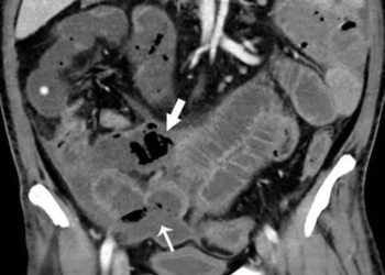Los escáneres de pacientes COVID-19 revelan lo que el Coronavirus puede hacer al intestino