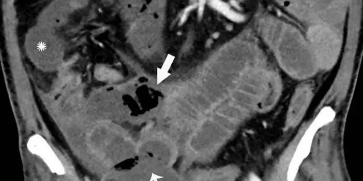 Los escáneres de pacientes COVID-19 revelan lo que el Coronavirus puede hacer al intestino
