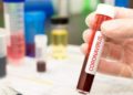 Análisis de sangre después de diagnóstico de COVID-19 predeciría la gravedad del virus