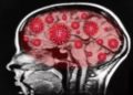 El coronavirus puede engañar a los anticuerpos para que ataquen el cerebro
