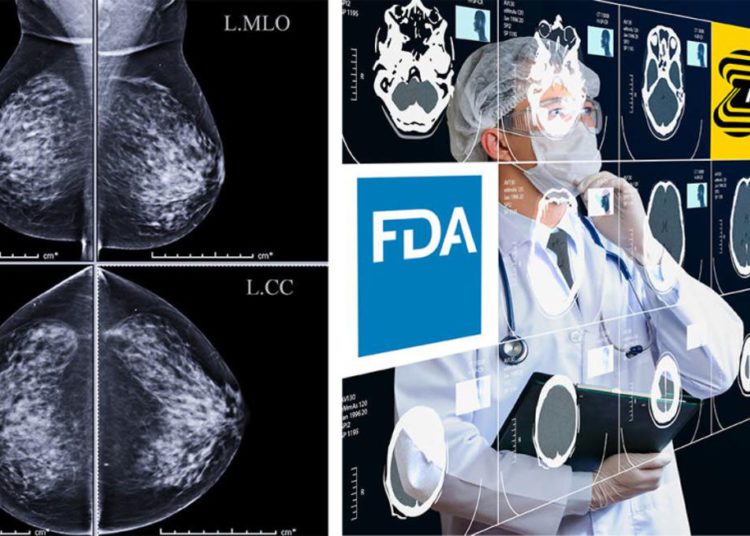 Startup israelí obtiene aprobación de la FDA para solución de cáncer de mama con IA