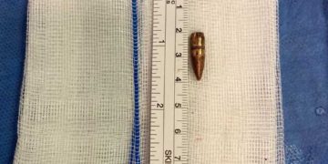 Médicos israelíes encuentran bala alojada en el cerebro de un niño de 9 años