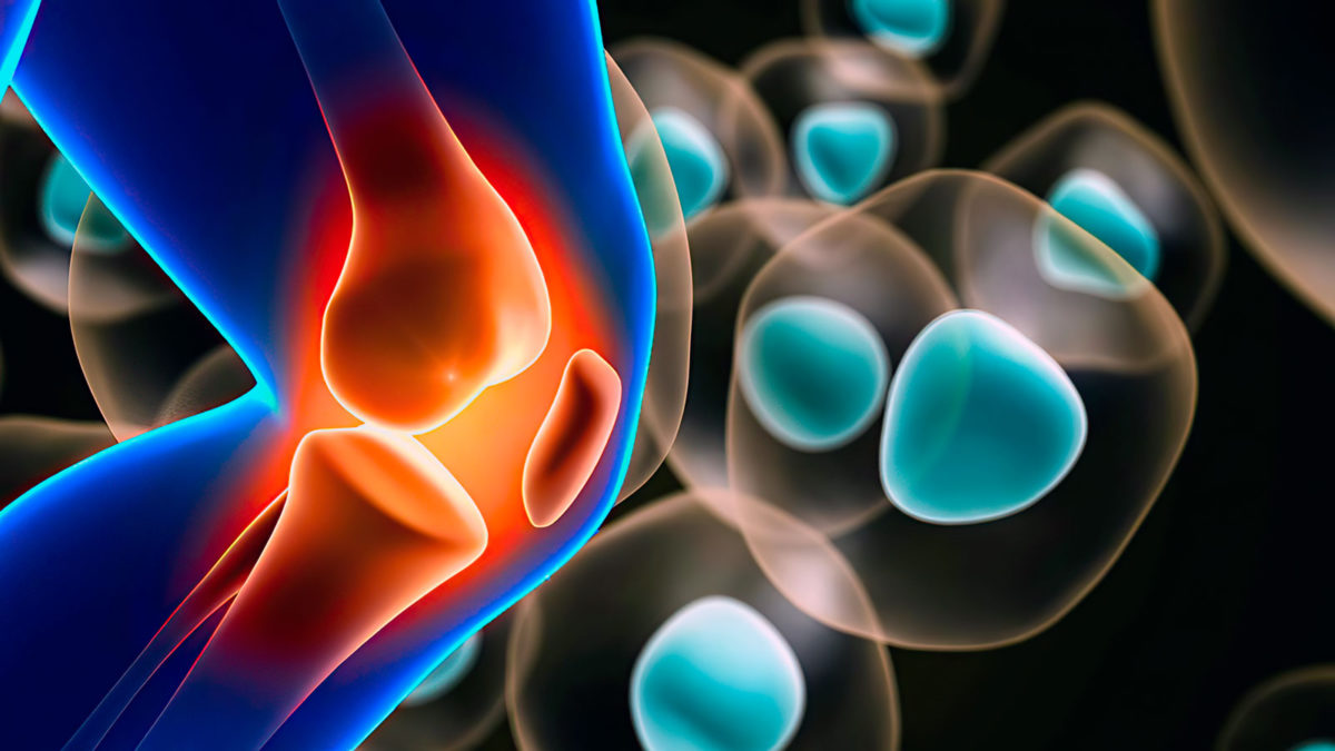 CartiHeal tiene éxito en ensayo clínico para el tratamiento del cartílago de la rodilla