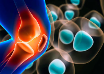 CartiHeal tiene éxito en ensayo clínico para el tratamiento del cartílago de la rodilla