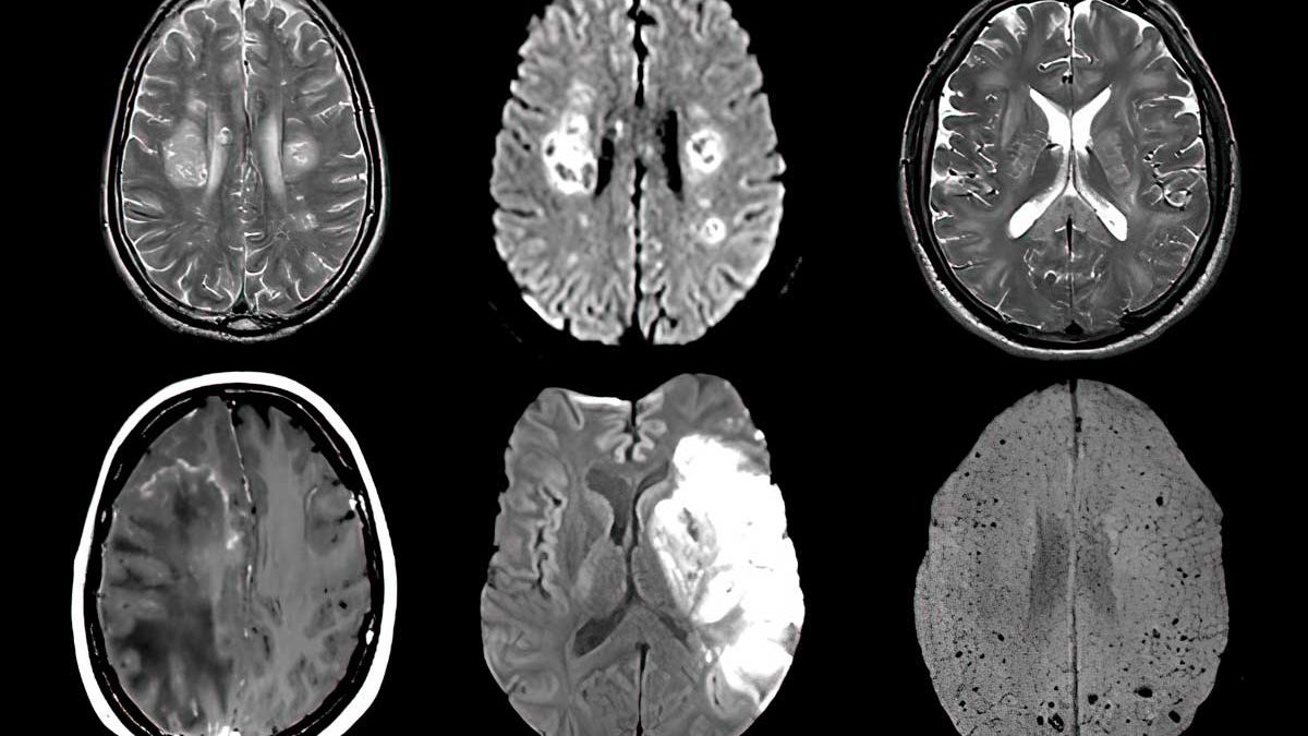 Científicos estudian la "niebla cerebral" post-COVID y su posible relación con el Alzheimer