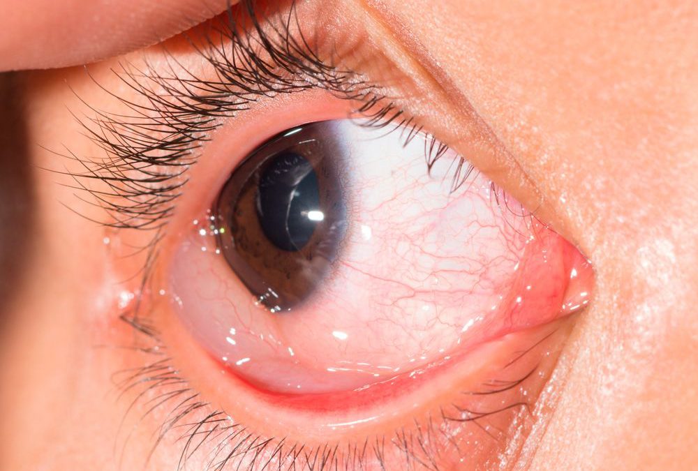 La vacuna de Pfizer contra el COVID es vinculada a casos de inflamación ocular