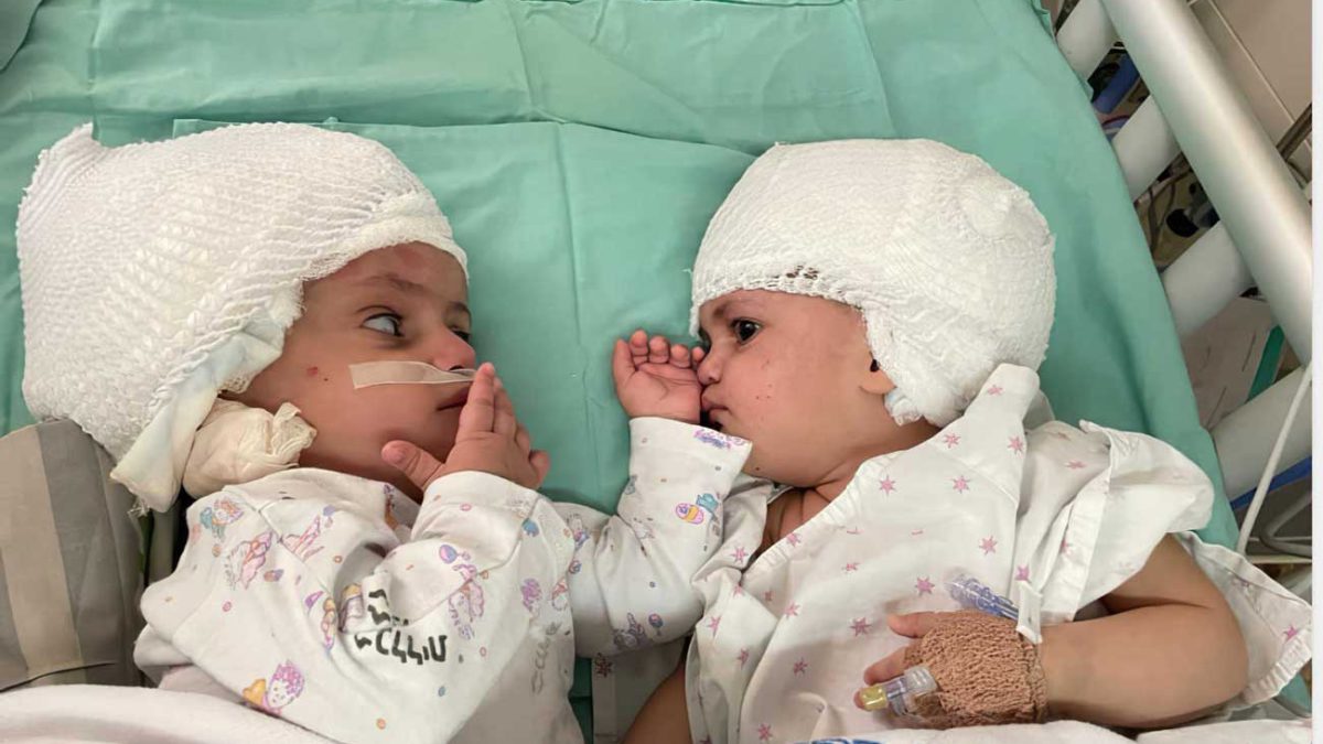Milagro quirúrgico en Israel: Médicos separan las cabezas de siameses de un año