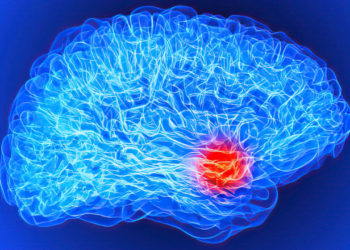 Se podría haber encontrado el origen de la esquizofrenia en el cerebro