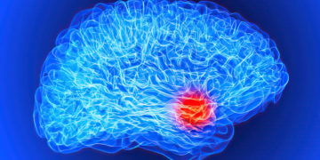 Se podría haber encontrado el origen de la esquizofrenia en el cerebro