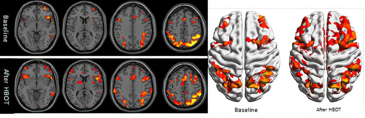 Ejemplo clínico de imágenes cerebrales funcionales por fMRI.  La actividad cerebral reducida en los lóbulos frontales del cerebro y en el hipocampo mejora tras la terapia de oxígeno hiperbárico (Cortesía/ Centro Médico Shamir)