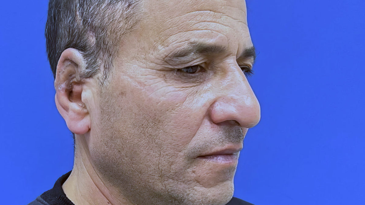 Médicos israelíes reconstruyen una oreja cortada en una operación única