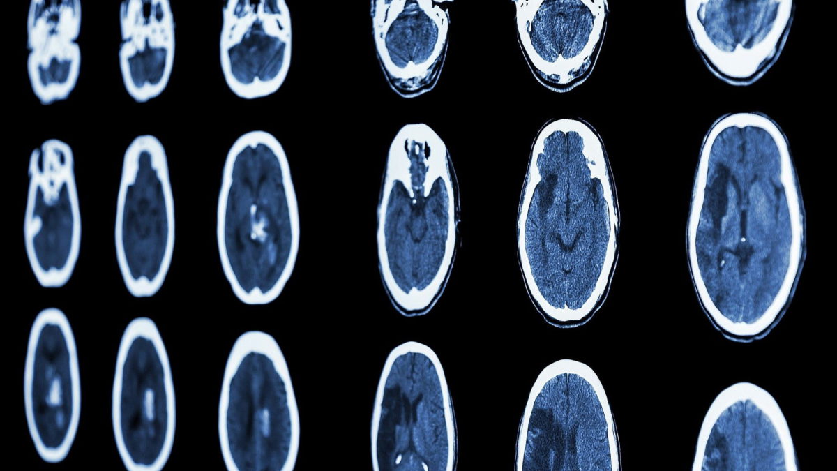 Viz.ai de Israel detecta enfermedades cerebrales con inteligencia artificial
