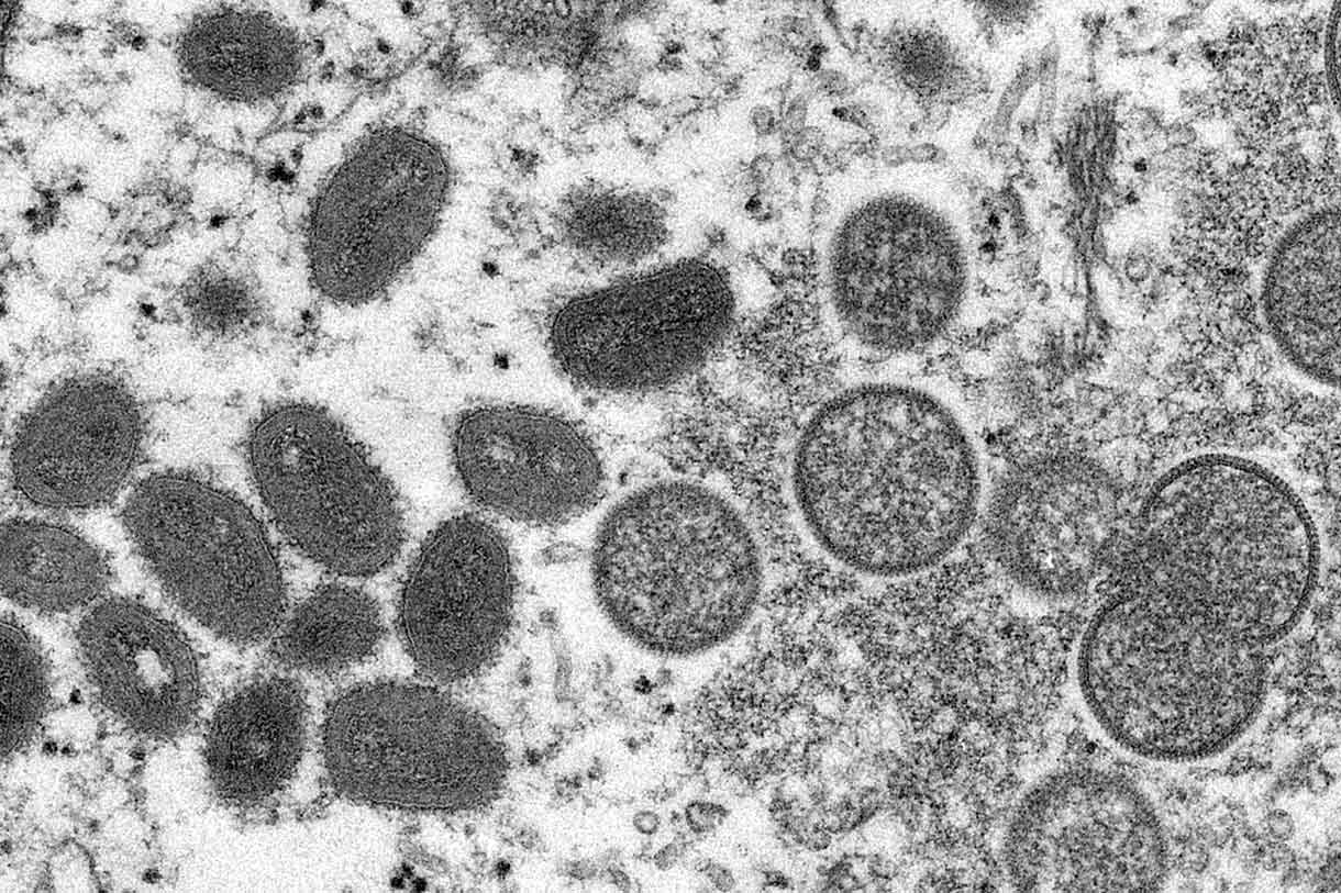 Viruela símica: ¿Hay otras enfermedades con riesgo de brotes generalizados?