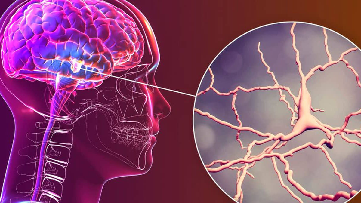 Células cerebrales específicas relacionadas con la enfermedad de Parkinson