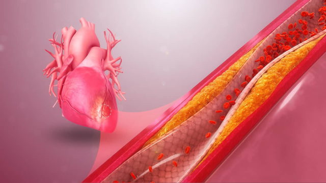 Estudio revela que los infartos de las mujeres son diferentes a los de los hombres
