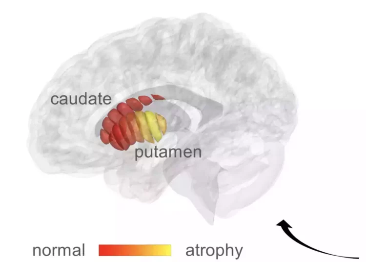 Laboratorio israelí desarrolla un escáner cerebral para la detección temprana del Parkinson