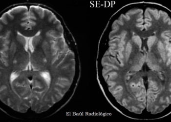 La empresas israelíes NeuroSense y NeuraLight colaboran para detectar la ELA mediante IA