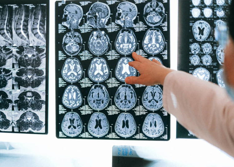 Universidad Hebrea asegura que será posible el diagnóstico temprano del Parkinson