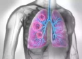 El líquido pulmonar puede servir de base para las vacunas contra el cáncer