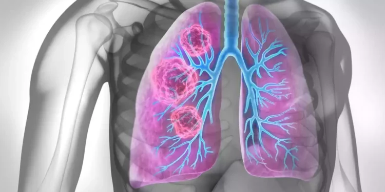 El líquido pulmonar puede servir de base para las vacunas contra el cáncer