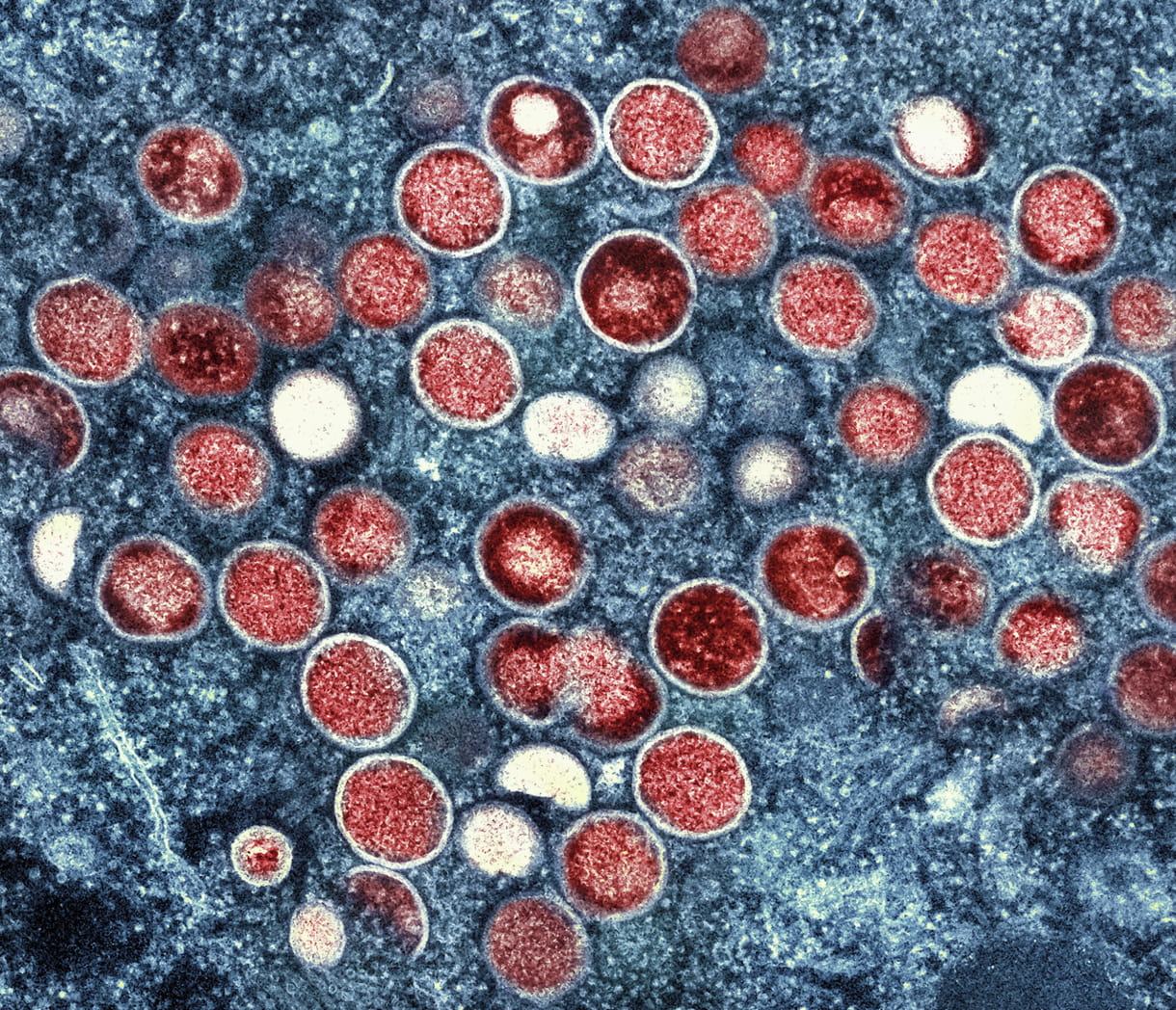 India informa de la primera muerte relacionada con la viruela símica en Asia
