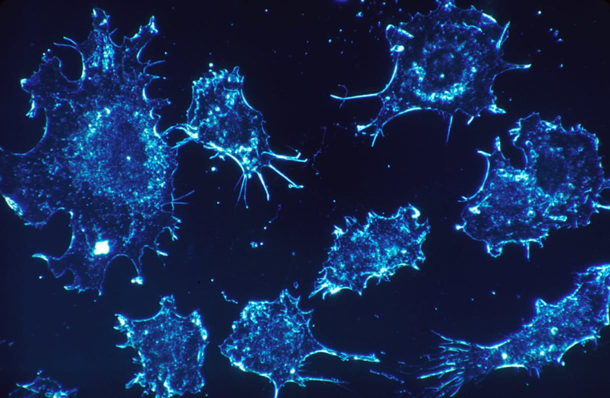 ¿Se puede diagnosticar el cáncer haciendo una biopsia líquida?