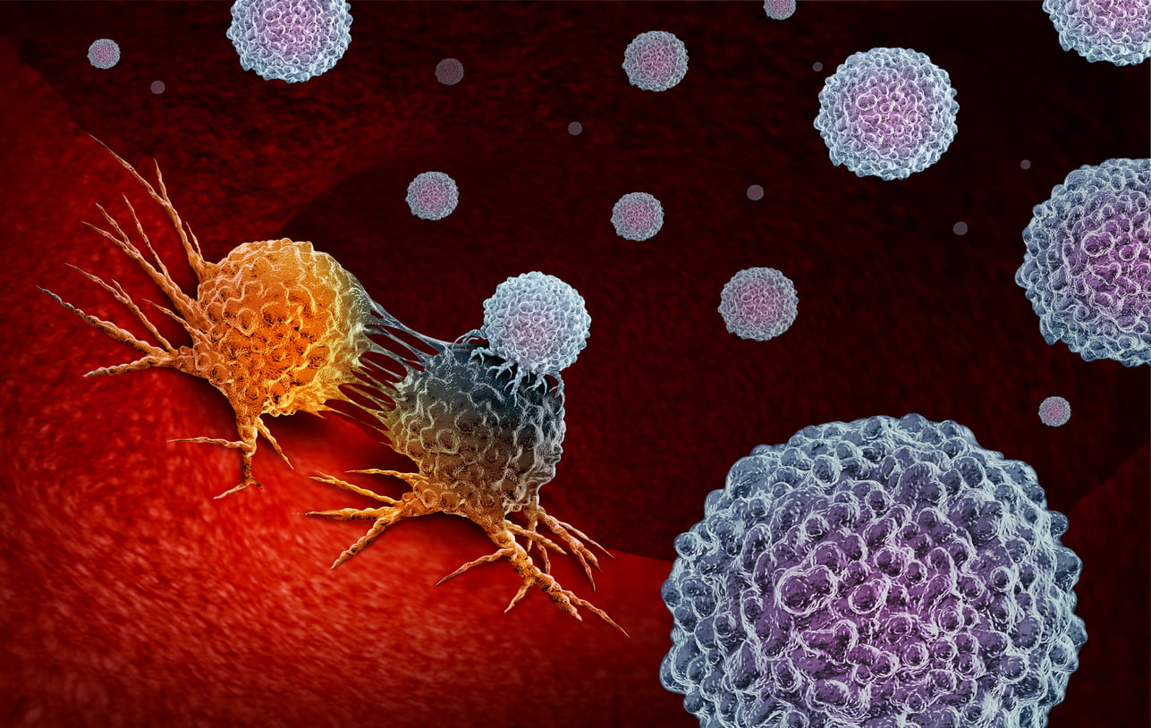 Cuerpo con células cancerosas como ejemplo (wildpixel; iStock by Getty Images)
