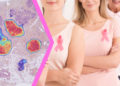 Israel tiene una alta tasa de supervivencia del cáncer de mama