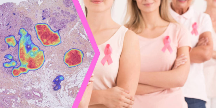 Israel tiene una alta tasa de supervivencia del cáncer de mama
