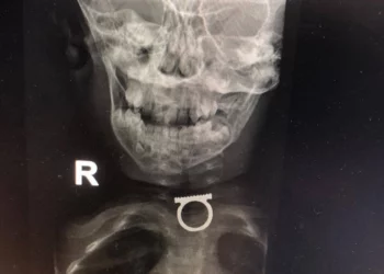 Médicos de Jerusalén salvan la vida de un niño que se tragó un anillo