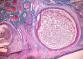 Estudio israelí: Nanofármacos de ARN detiene el cáncer de ovario